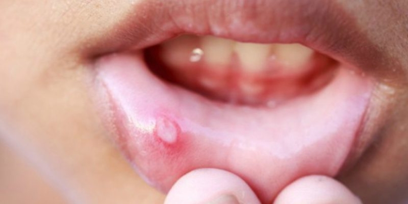 5 unexpected diseases that are transmitted through a kiss