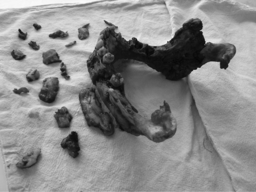 8 enfermedades terribles y simplemente inexplicables del pasado