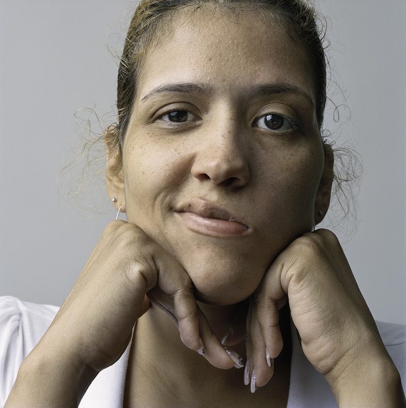 About Face: photo portraits of people suffering from paralysis