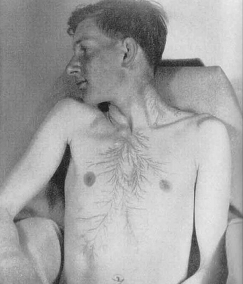 After discharge: what happens to a man who was struck by lightning