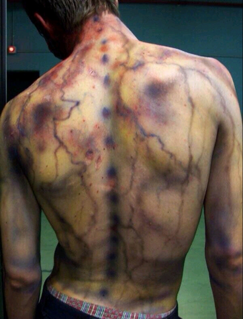 After discharge: what happens to a man who was struck by lightning