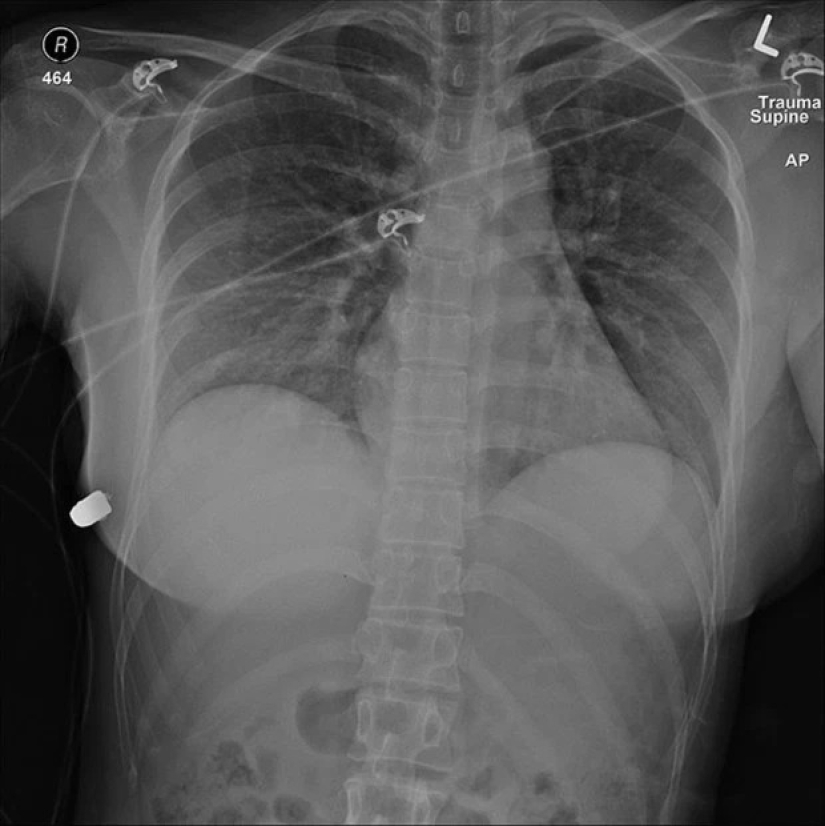 Airbag: stories of women whose breast implants saved their lives Airbag: stories of women whose breast implants saved their lives