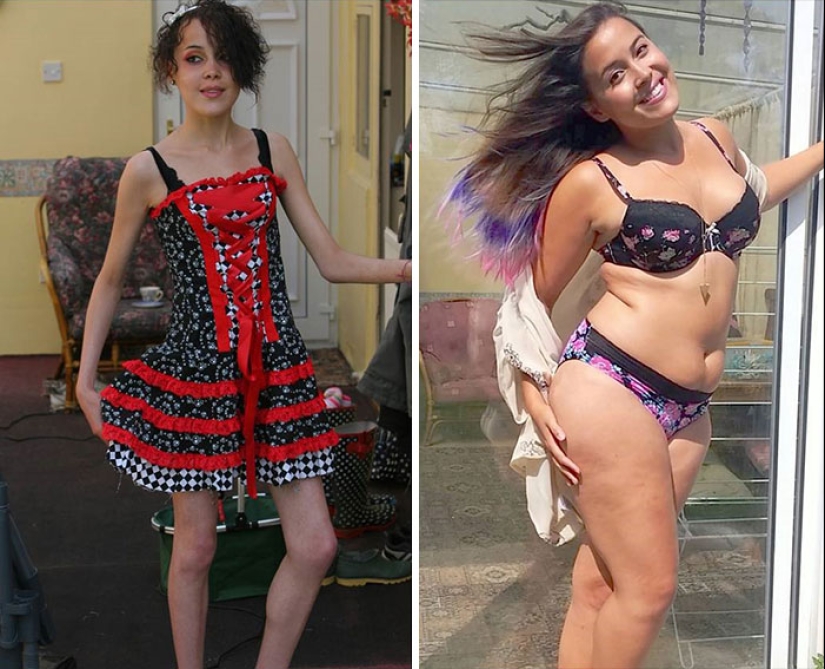 Antes y después: 20 ejemplos de personas que lograron superar la anorexia Antes y después: 20 ejemplos de personas que lograron superar la anorexia