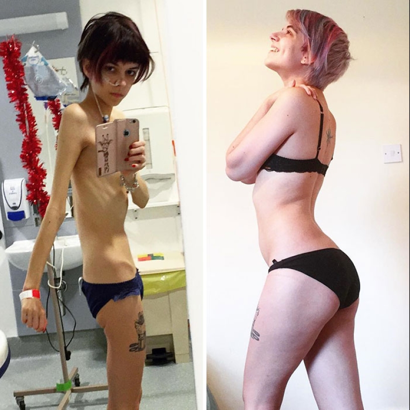 Antes y después: 20 ejemplos de personas que lograron superar la anorexia Antes y después: 20 ejemplos de personas que lograron superar la anorexia