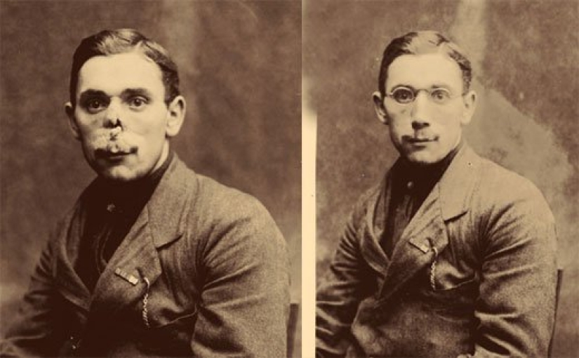 Cotton wool, solarium, tea bags and 12 more inventions that appeared thanks to the First World War