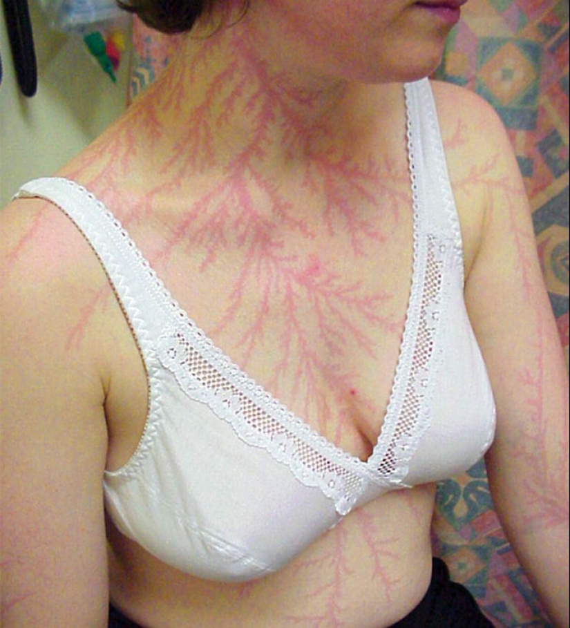 Después de la descarga: ¿qué le sucede a un hombre que fue alcanzado por un rayo Después de la descarga: ¿qué le sucede a un hombre que fue alcanzado por un rayo