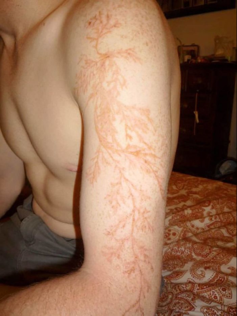 Después de la descarga: ¿qué le sucede a un hombre que fue alcanzado por un rayo Después de la descarga: ¿qué le sucede a un hombre que fue alcanzado por un rayo