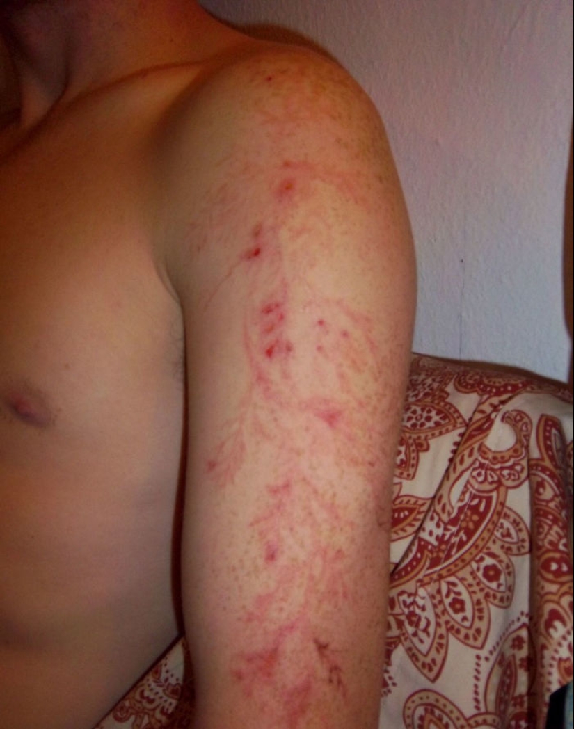 Después de la descarga: ¿qué le sucede a un hombre que fue alcanzado por un rayo Después de la descarga: ¿qué le sucede a un hombre que fue alcanzado por un rayo