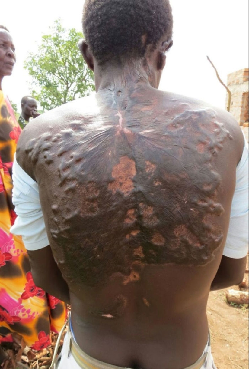 Después de la descarga: ¿qué le sucede a un hombre que fue alcanzado por un rayo Después de la descarga: ¿qué le sucede a un hombre que fue alcanzado por un rayo