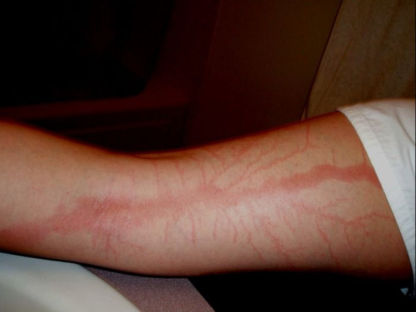 Después de la descarga: ¿qué le sucede a un hombre que fue alcanzado por un rayo Después de la descarga: ¿qué le sucede a un hombre que fue alcanzado por un rayo