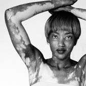 Discover the beauty of vitiligo