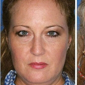 Effects of smoking on the example of twins