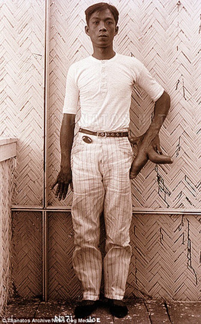 El duro siglo XIX: una colección de fotografías de archivo de personas con deformidades El duro siglo XIX: una colección de fotografías de archivo de personas con deformidades