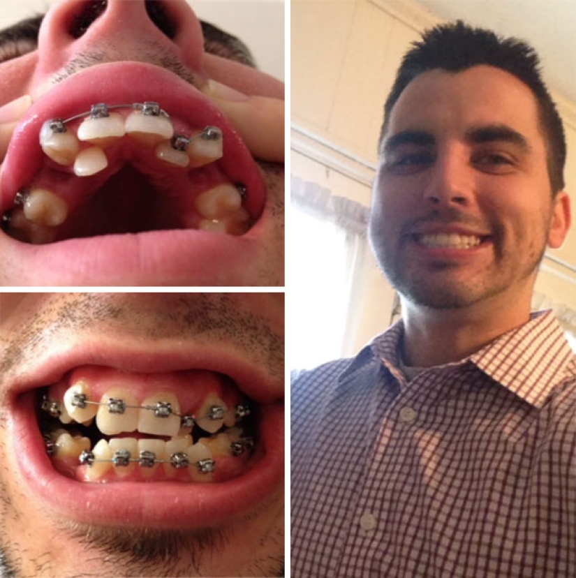 Here's how radically braces change a smile and life Here's how radically braces change a smile and life