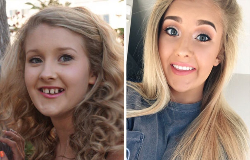 Here's how radically braces change a smile and life Here's how radically braces change a smile and life