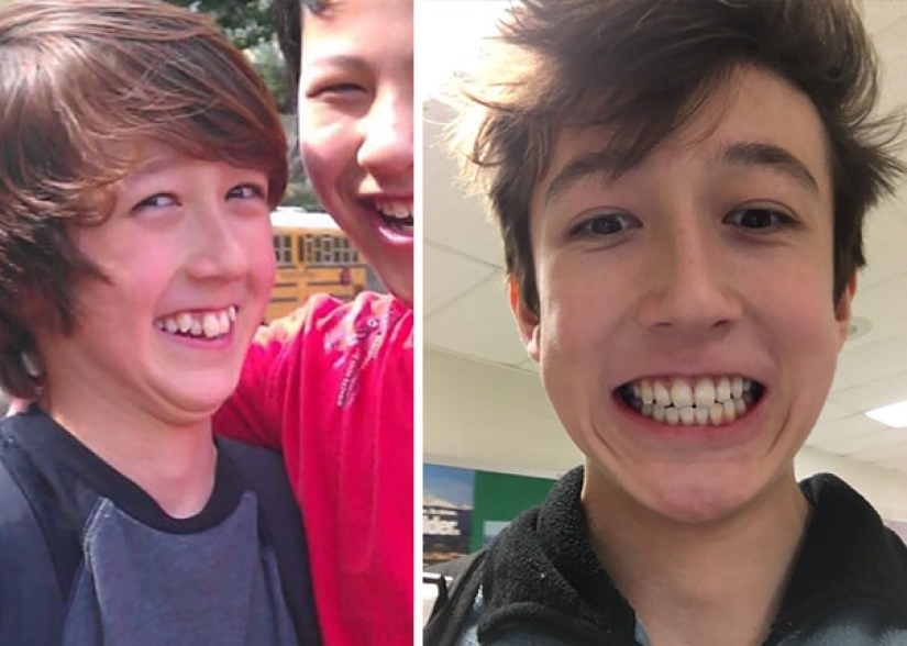 Here's how radically braces change a smile and life Here's how radically braces change a smile and life