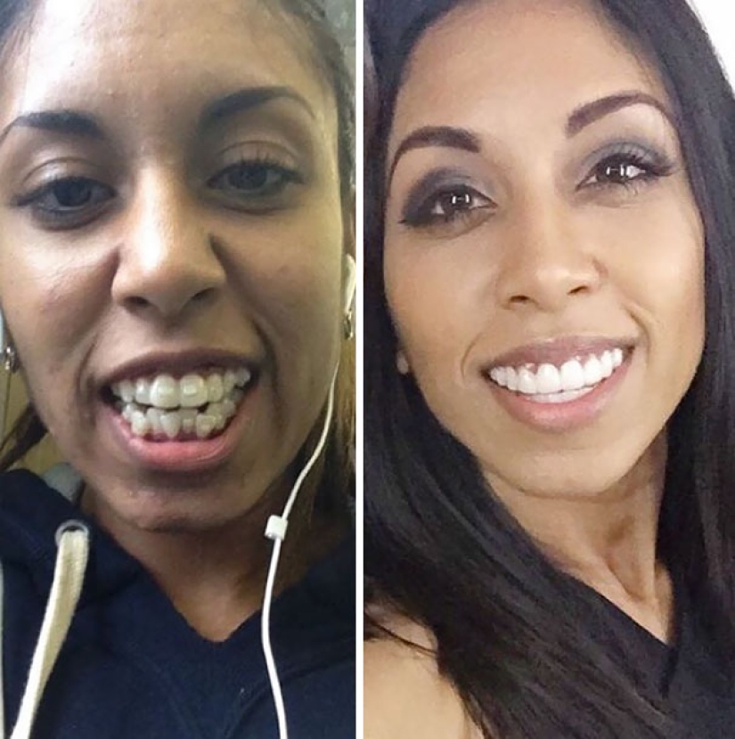Here's how radically braces change a smile and life Here's how radically braces change a smile and life