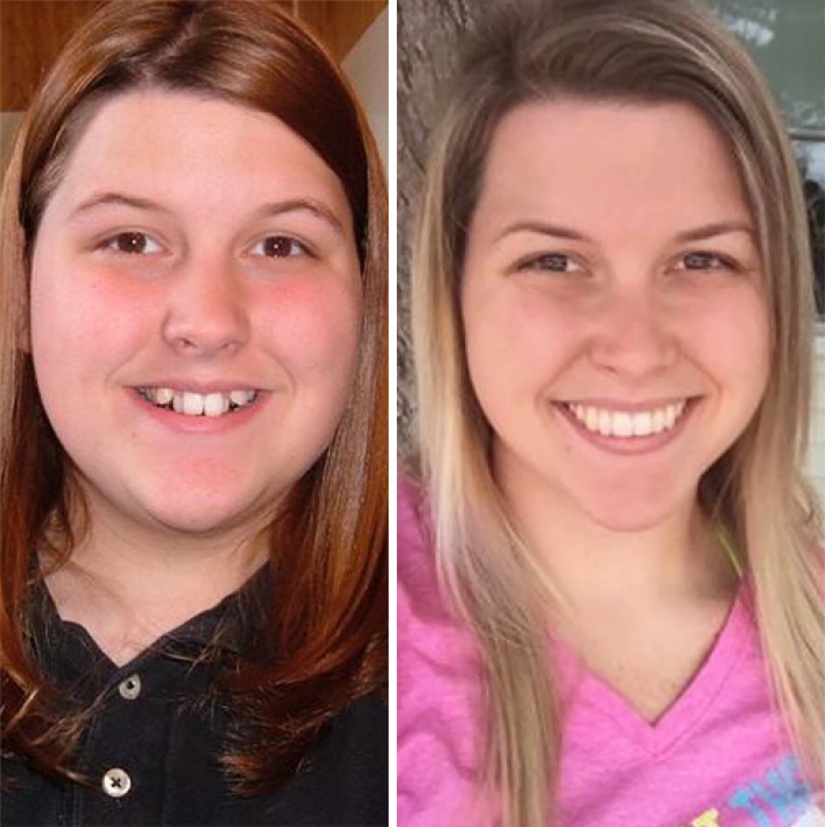 Here's how radically braces change a smile and life Here's how radically braces change a smile and life