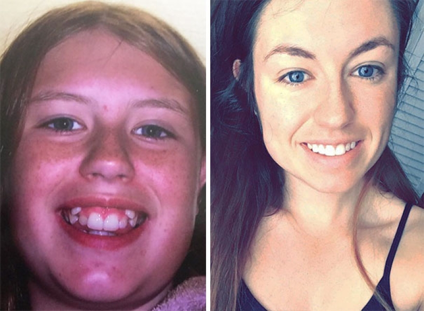 Here's how radically braces change a smile and life Here's how radically braces change a smile and life