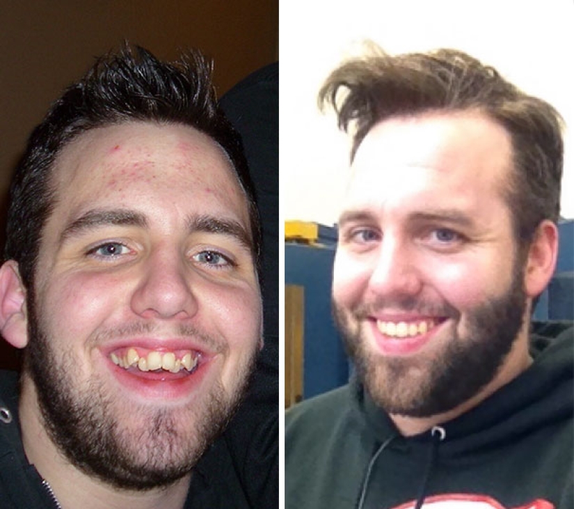 Here's how radically braces change a smile and life Here's how radically braces change a smile and life