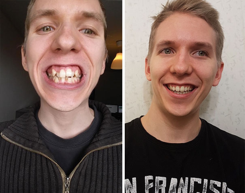 Here's how radically braces change a smile and life Here's how radically braces change a smile and life