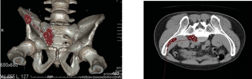 ¿Hubo una oportunidad de salvar a Pushkin después del duelo? Opinión de especialistas modernos ¿Hubo una oportunidad de salvar a Pushkin después del duelo? Opinión de especialistas modernos