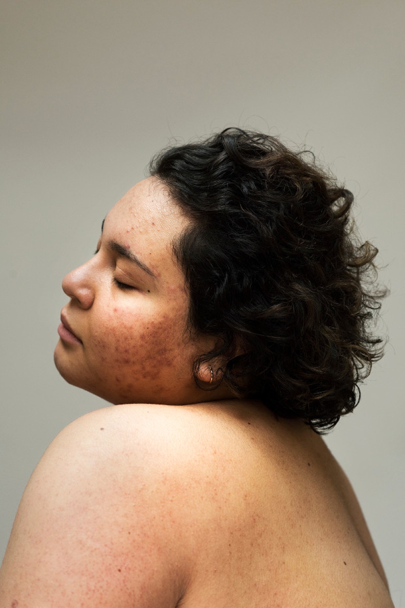 In your skin: a powerful photo project "Epidermis" by Sophie Harris-Taylor In your skin: a powerful photo project "Epidermis" by Sophie Harris-Taylor