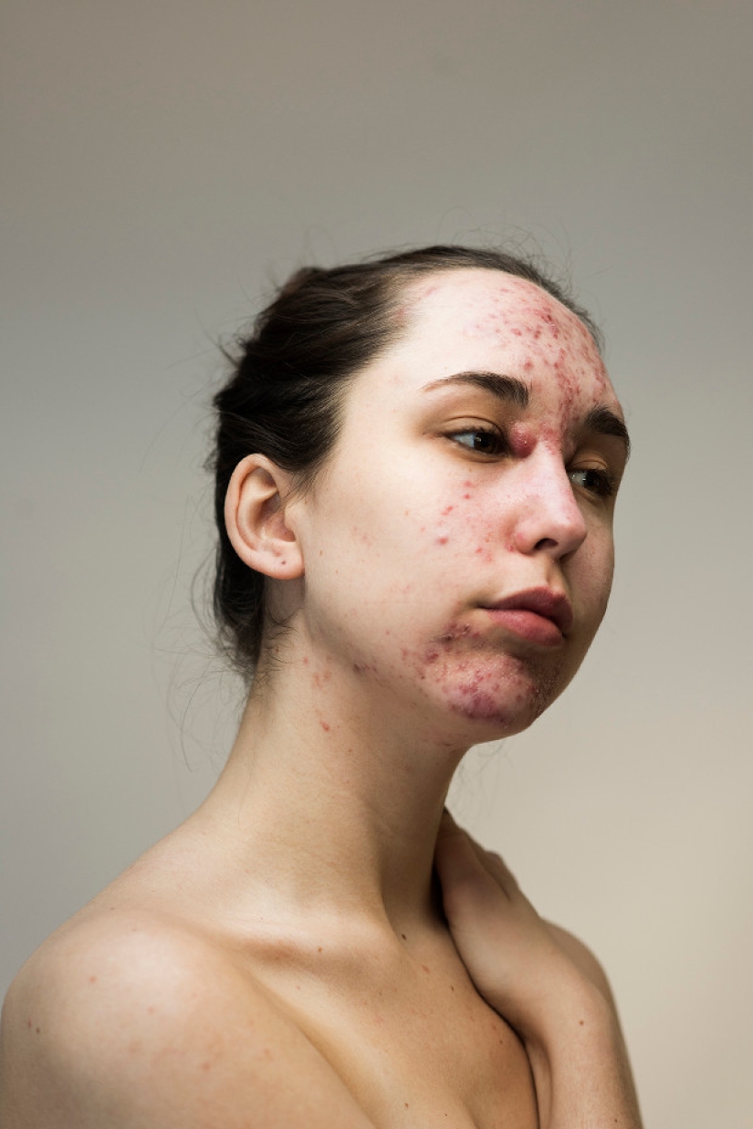 In your skin: a powerful photo project "Epidermis" by Sophie Harris-Taylor In your skin: a powerful photo project "Epidermis" by Sophie Harris-Taylor