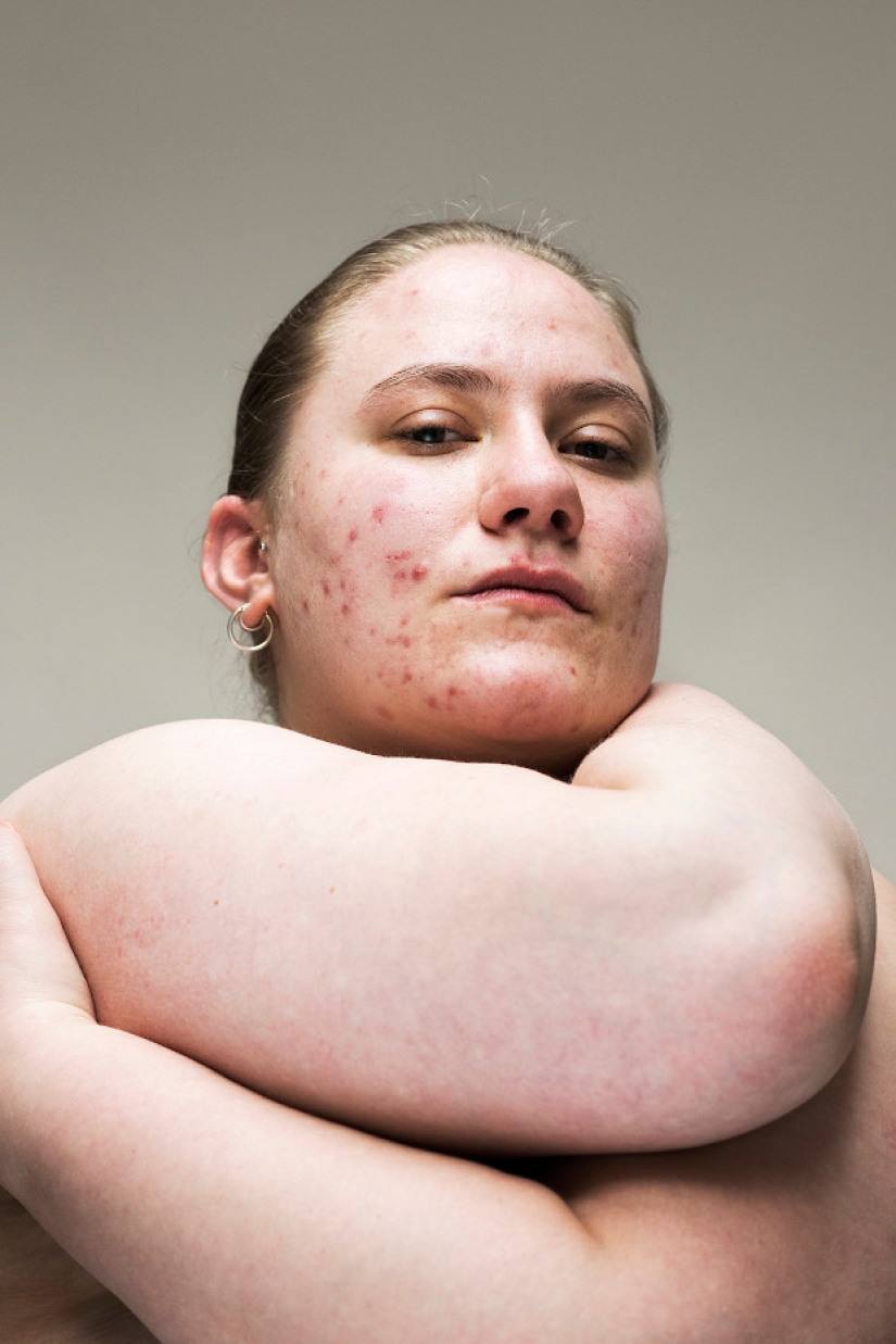 In your skin: a powerful photo project "Epidermis" by Sophie Harris-Taylor In your skin: a powerful photo project "Epidermis" by Sophie Harris-Taylor