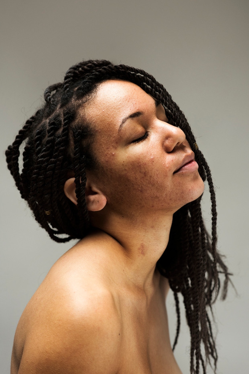 In your skin: a powerful photo project "Epidermis" by Sophie Harris-Taylor In your skin: a powerful photo project "Epidermis" by Sophie Harris-Taylor