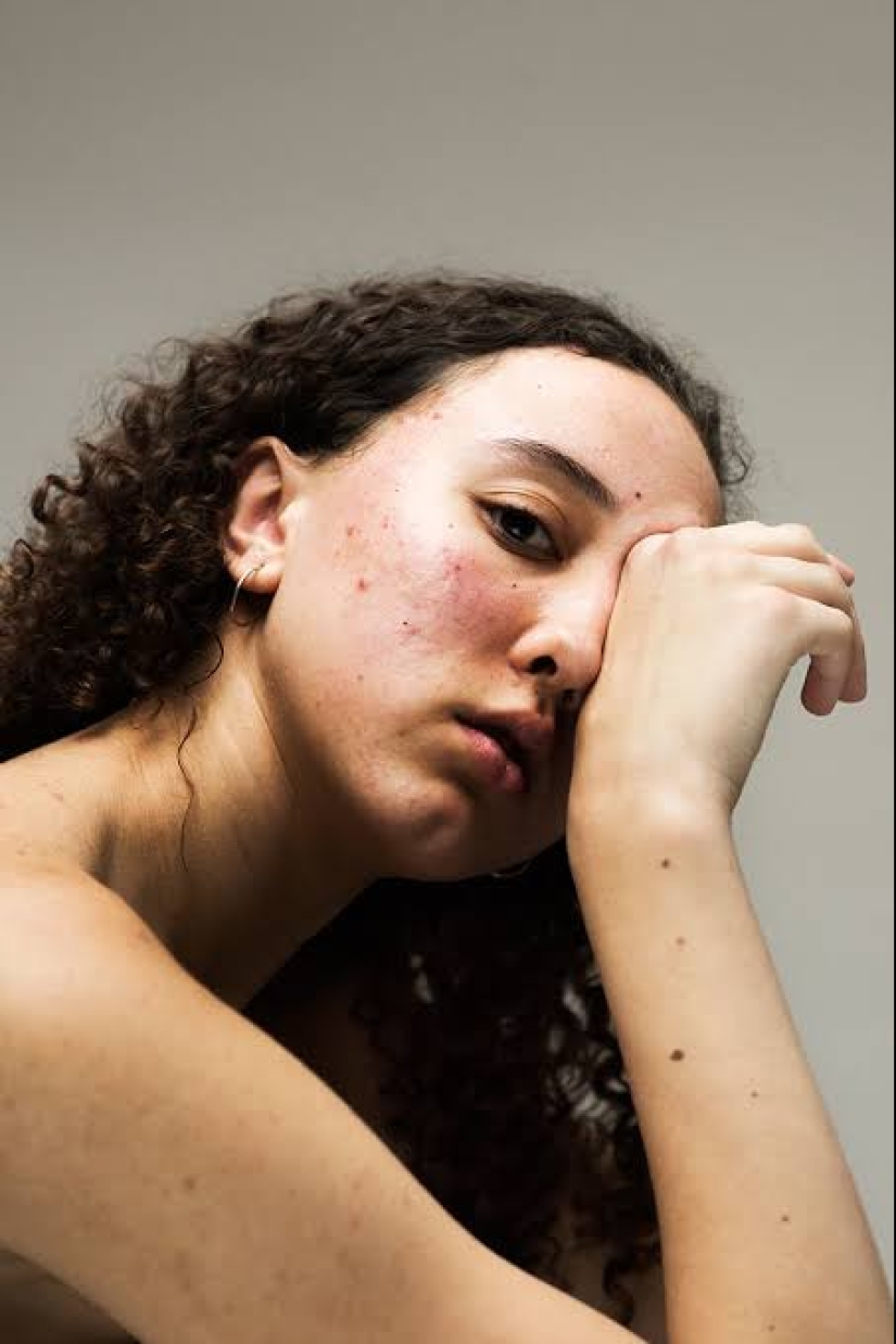 In your skin: a powerful photo project "Epidermis" by Sophie Harris-Taylor In your skin: a powerful photo project "Epidermis" by Sophie Harris-Taylor