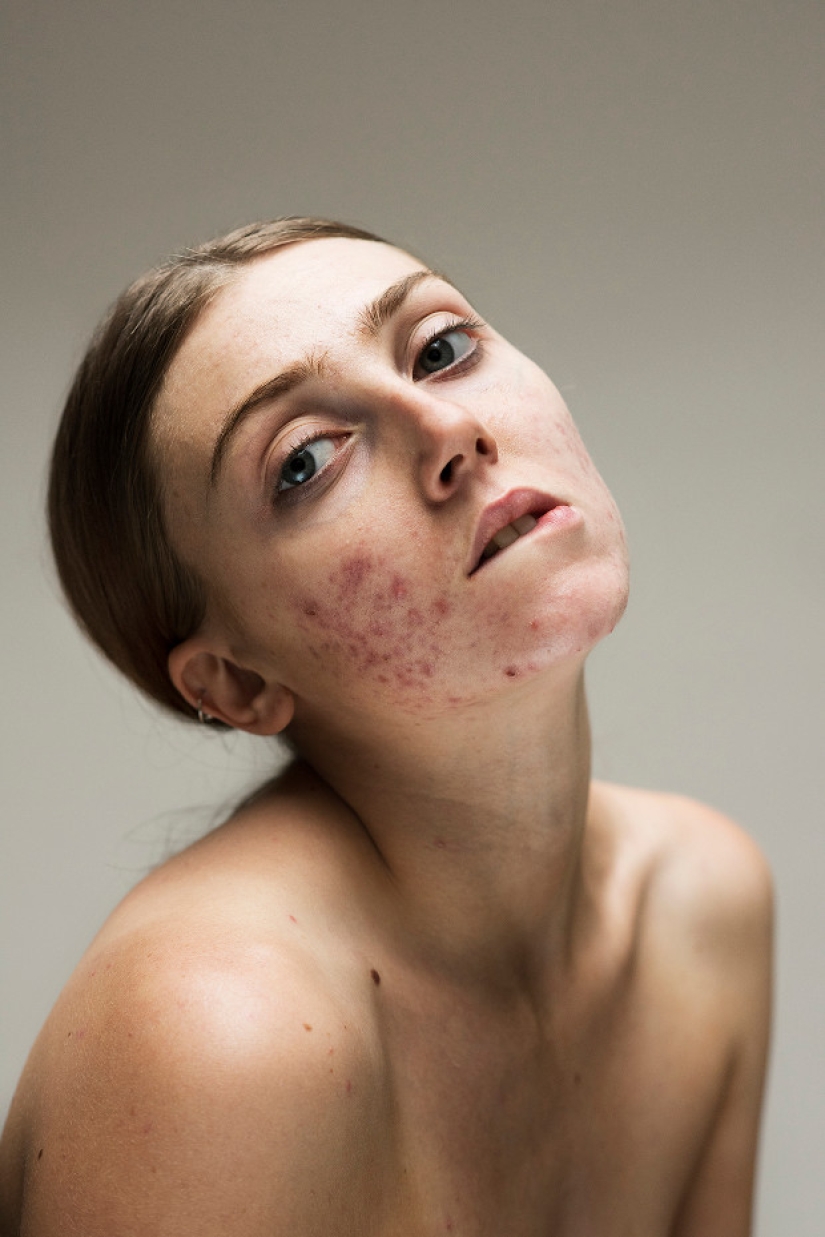 In your skin: a powerful photo project "Epidermis" by Sophie Harris-Taylor In your skin: a powerful photo project "Epidermis" by Sophie Harris-Taylor