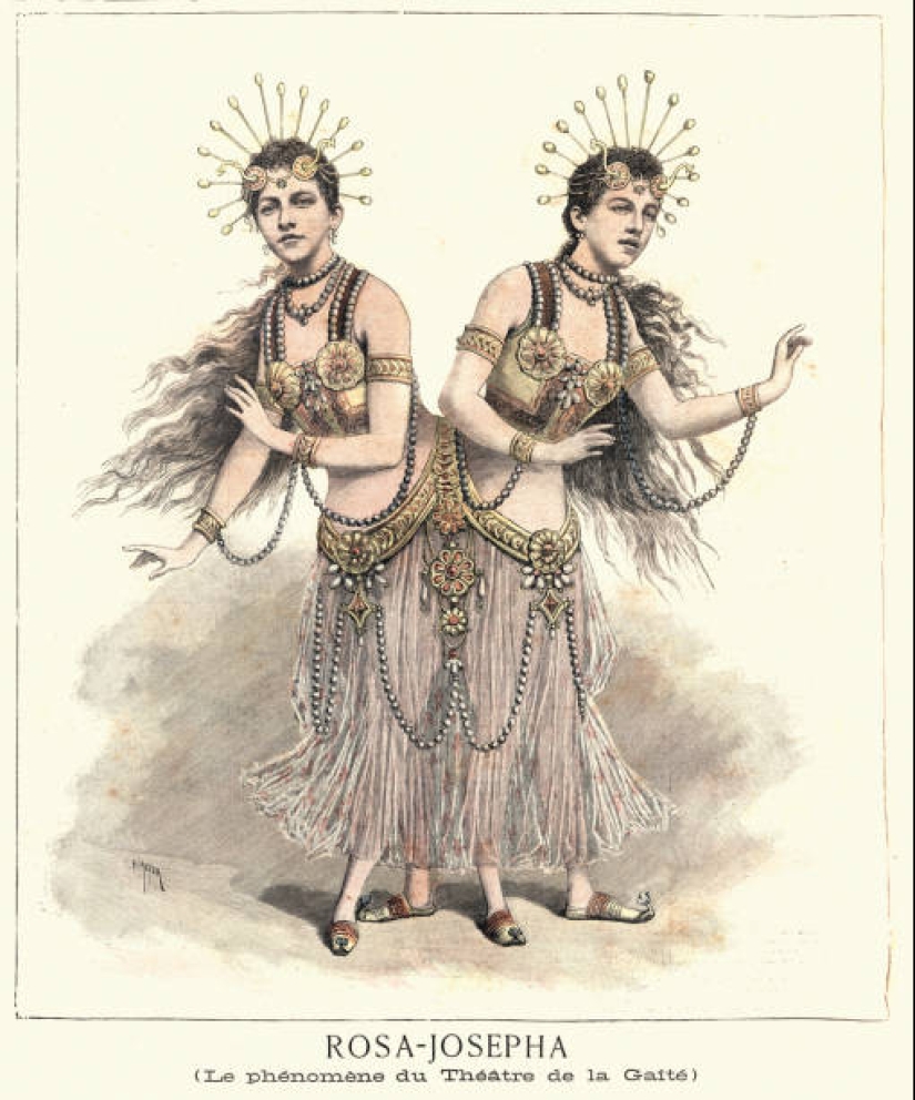 La historia de dos siamesas, las hermanas Blazek, una de las cuales dio a luz a un niño. La historia de dos siamesas, las hermanas Blazek, una de las cuales dio a luz a un niño.