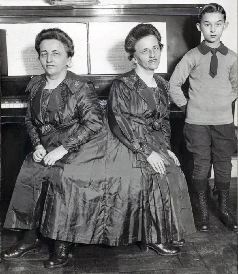 La historia de dos siamesas, las hermanas Blazek, una de las cuales dio a luz a un niño. La historia de dos siamesas, las hermanas Blazek, una de las cuales dio a luz a un niño.