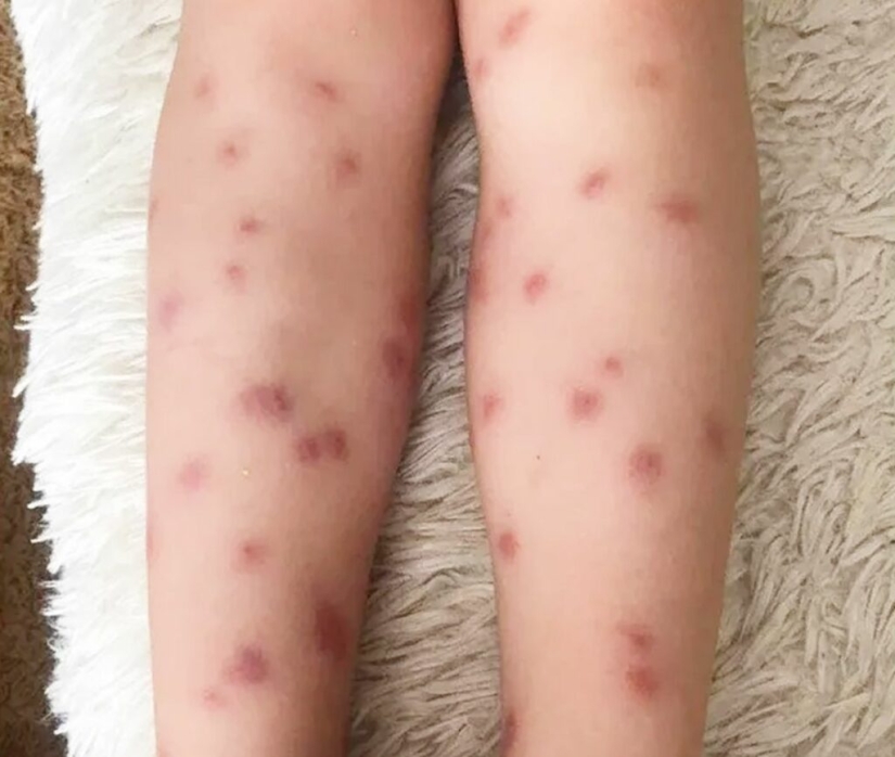 ¿Por qué son peligrosas las cercarias, parásitos del agua de los ríos que penetran la piel?