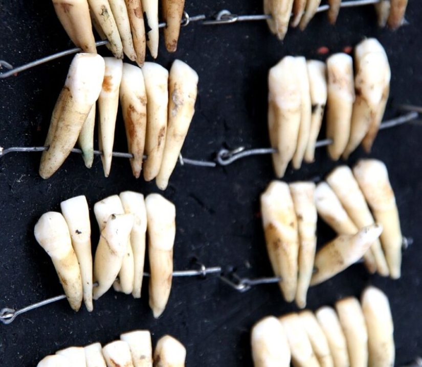 ¿Qué es el "Waterloo dientes", o Como la batalla de 1815 influido en el desarrollo de la odontología ¿Qué es el "Waterloo dientes", o Como la batalla de 1815 influido en el desarrollo de la odontología