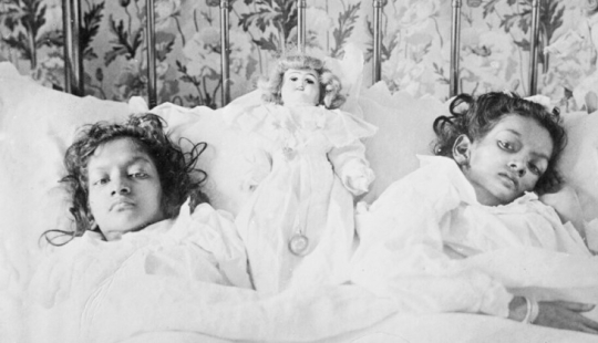 Radhika and Dudika Neik: The tragic fate of conjoined twins who were unfortunately separated