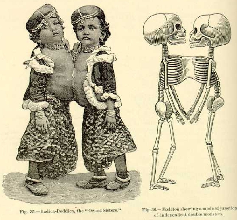 Radhika y Dudika Neik: El trágico destino de las siamesas que lamentablemente fueron separadas Radhika y Dudika Neik: El trágico destino de las siamesas que lamentablemente fueron separadas