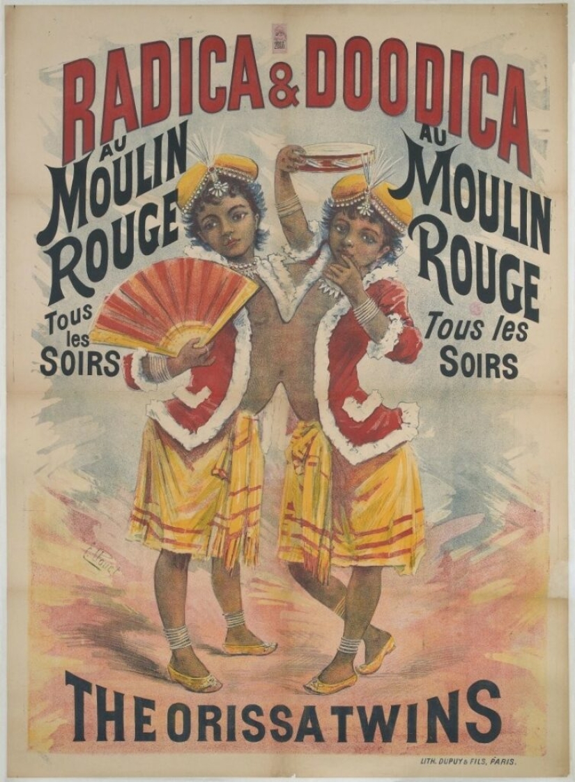 Radhika y Dudika Neik: El trágico destino de las siamesas que lamentablemente fueron separadas Radhika y Dudika Neik: El trágico destino de las siamesas que lamentablemente fueron separadas