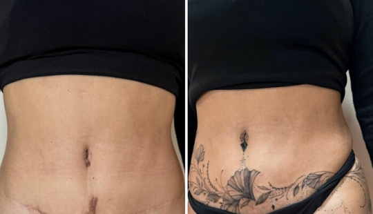 Tattoo Artist Covers Scars With Delicate Designs, And Here Are Her 10 Best Transformations