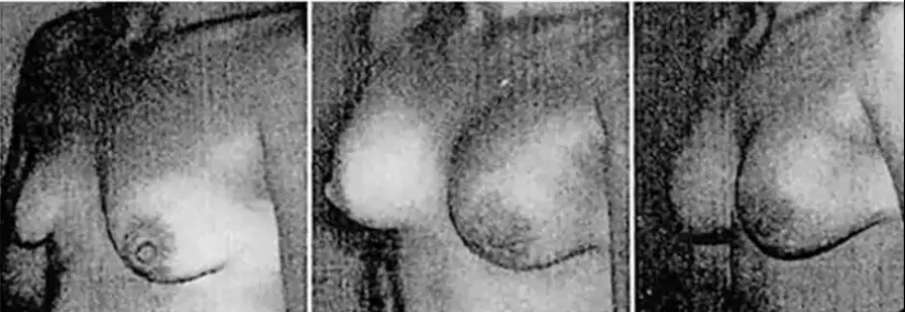 The fate of Timmie Jean Lindsay, the first woman to have breast augmentation
