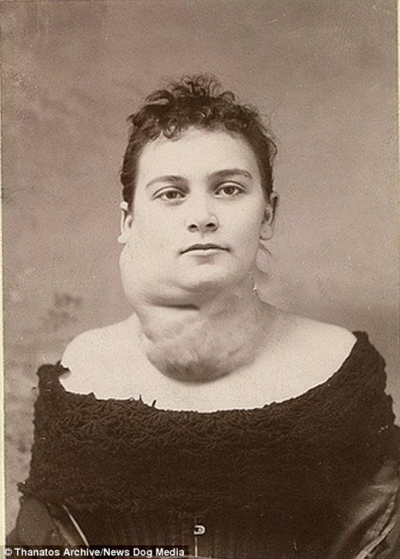 The harsh 19th century: a collection of archival photographs of people with deformities