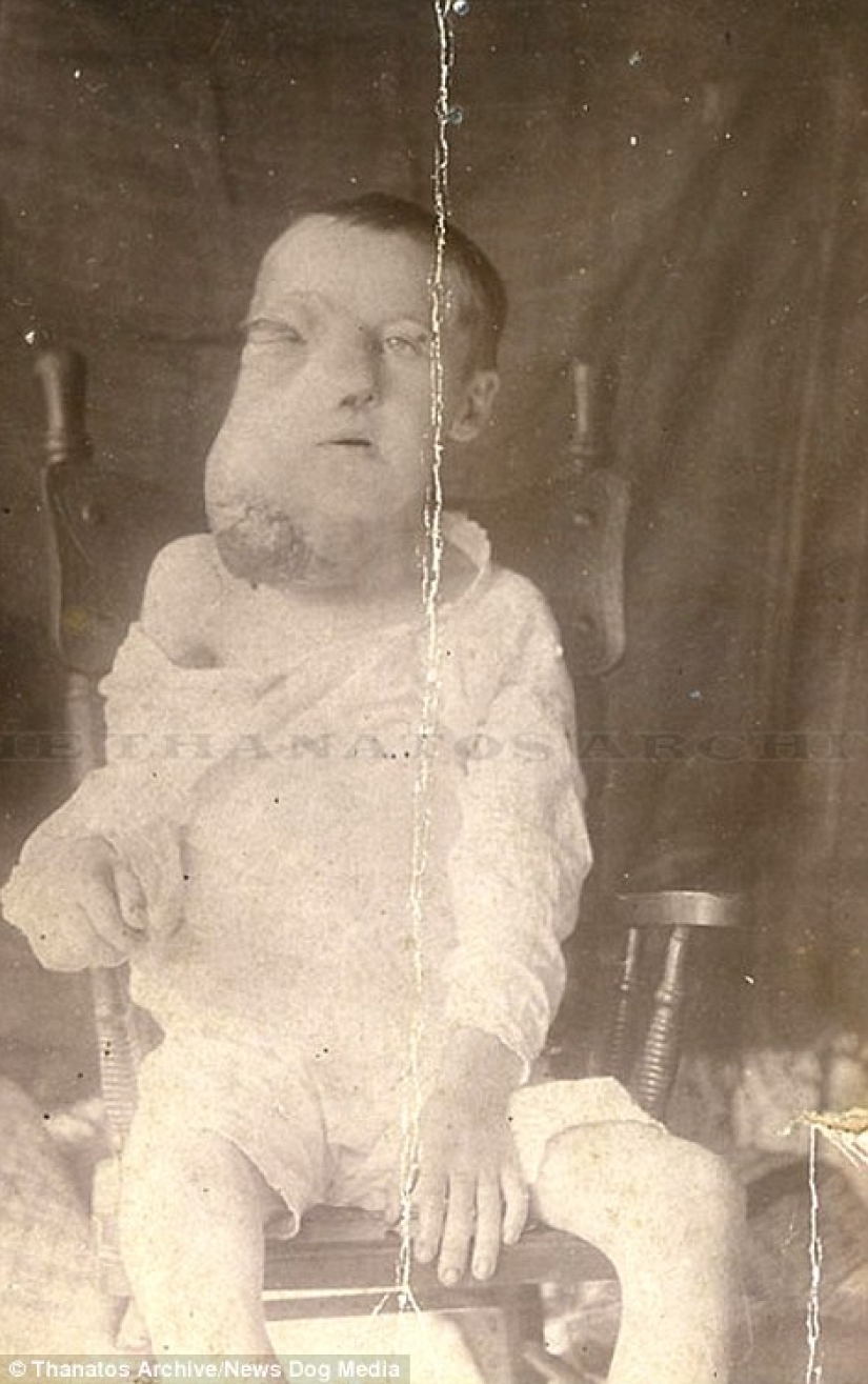 The harsh 19th century: a collection of archival photographs of people with deformities