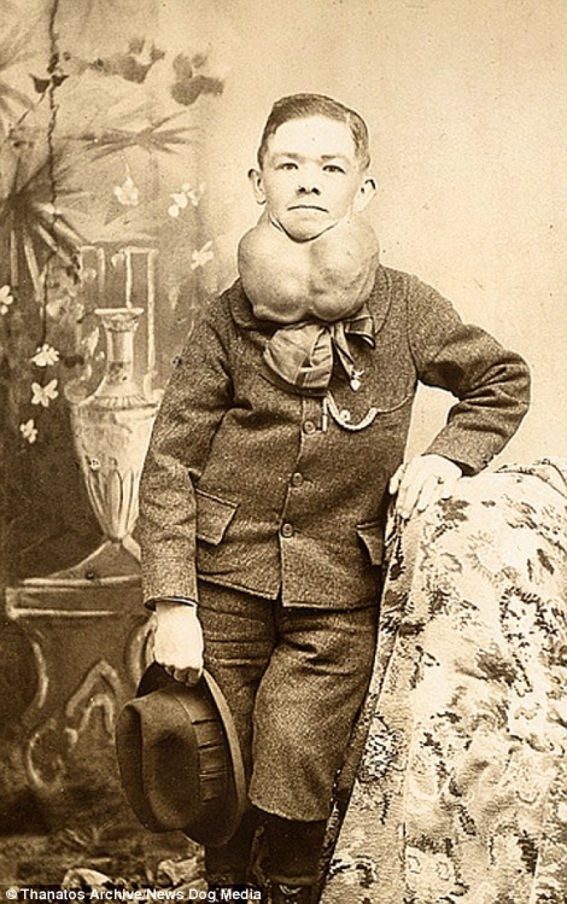 The harsh 19th century: a collection of archival photographs of people with deformities