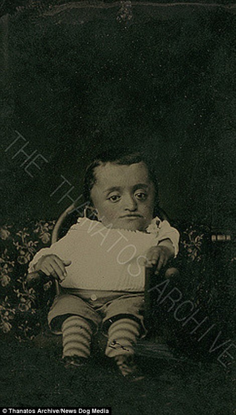 The harsh 19th century: a collection of archival photographs of people with deformities