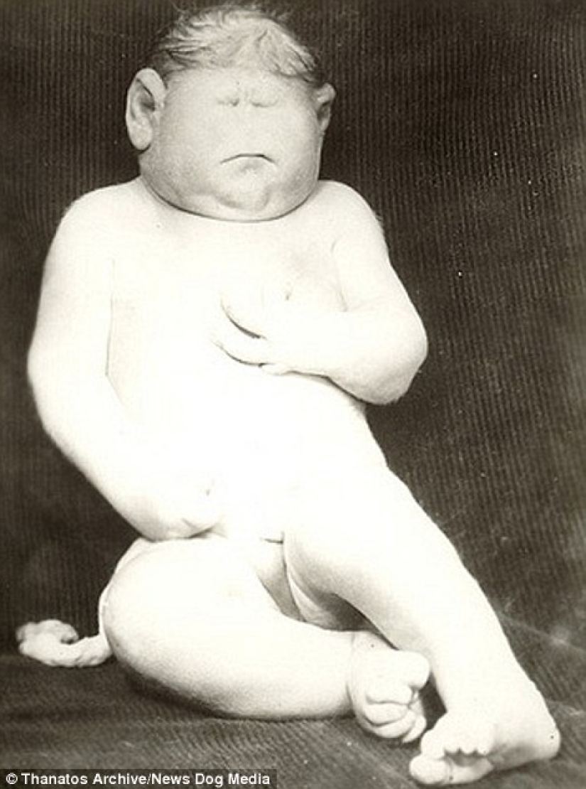 The harsh 19th century: a collection of archival photographs of people with deformities