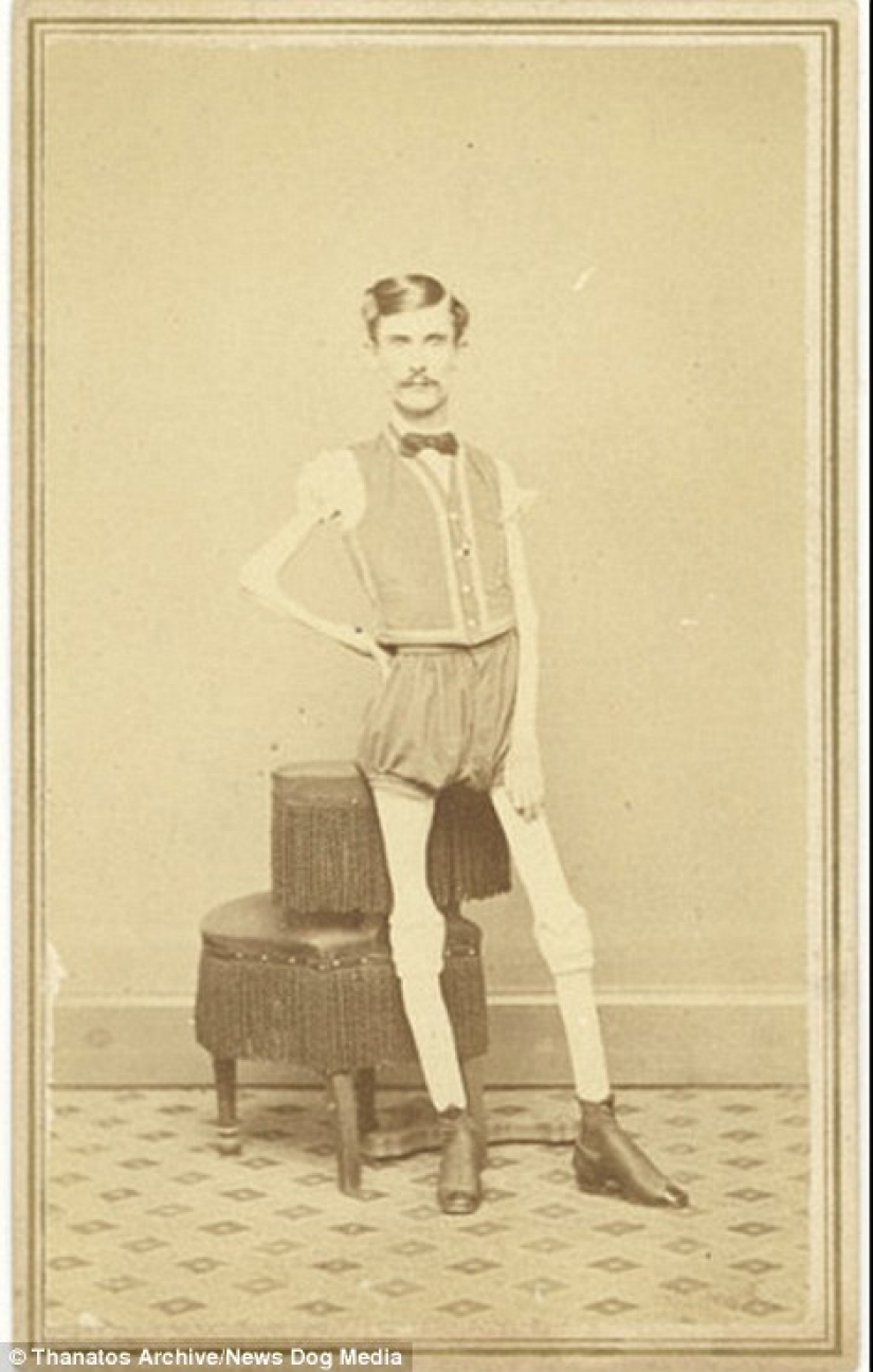 The harsh 19th century: a collection of archival photographs of people with deformities