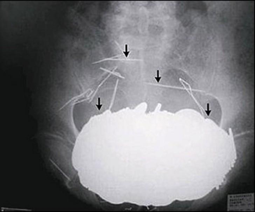 The most incredible objects that have been found in the human body