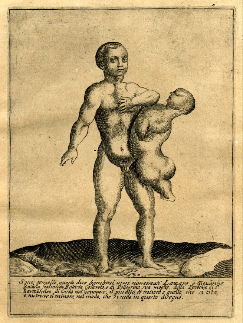 The story of the Siamese twins Colloredo, who managed to become musketeers of the King of France