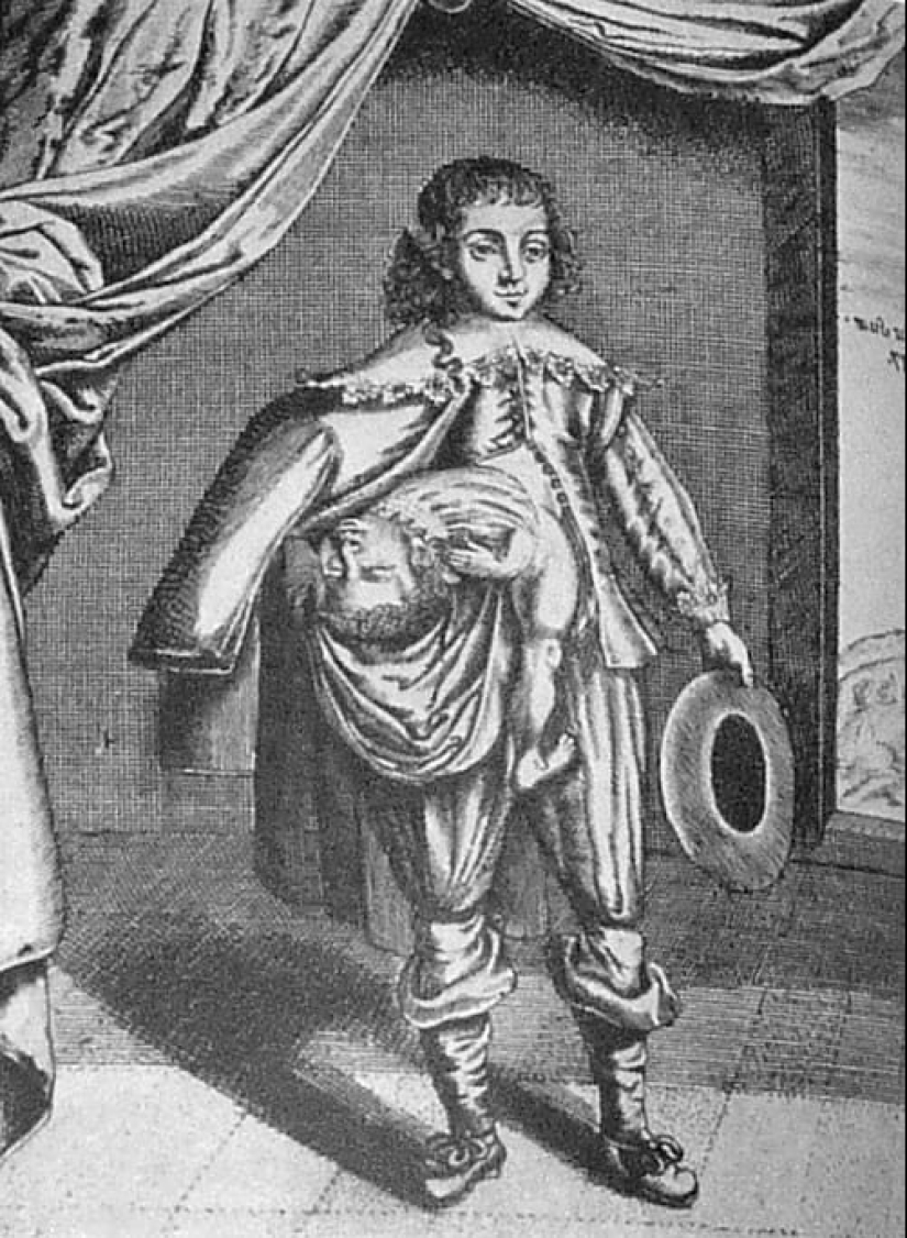 The story of the Siamese twins Colloredo, who managed to become musketeers of the King of France